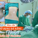 Bật mí địa chỉ hút mỡ bụng Đà Nẵng an toàn, hiệu quả - Viện Thẩm Mỹ ViolaEva