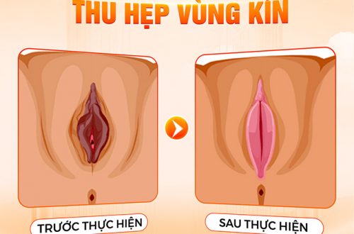 Tại sao cần thu hẹp vùng kín?