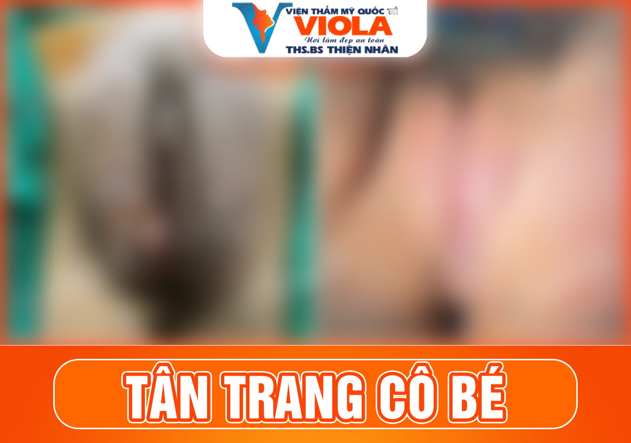ket-qua-cat-moi-be-da-nang