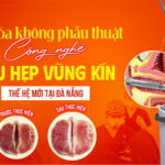 tre-hoa-khong-phau-thuat-voi-cong-nghe-thu-hep-vung-kin-the-he-moi-tai-da-nang